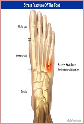 fraktura tibije oporavak artrita articulațiilor degetelor decât a trata
